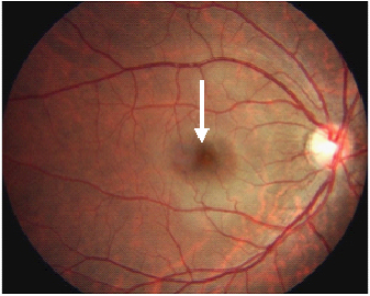 正常の眼底写真
