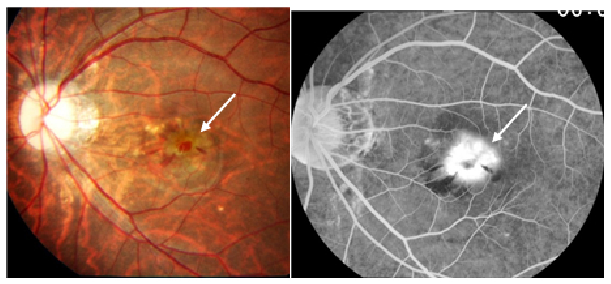 強度近視の黄斑部出血