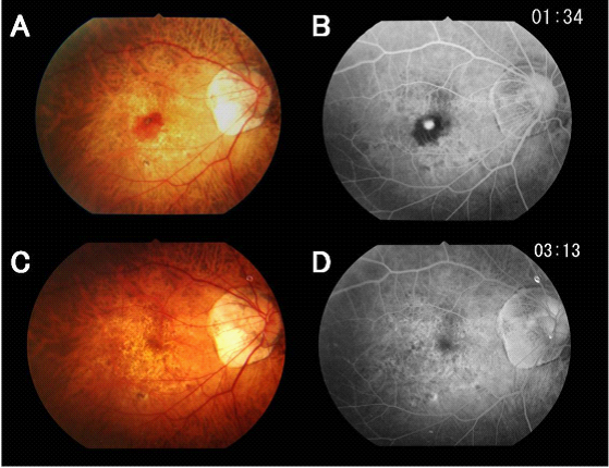 抗VEGF療法により治癒した新生血管を伴う黄斑部出血の症例