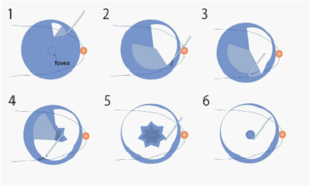 中心窩周囲内境界膜剥離術のシェーマ