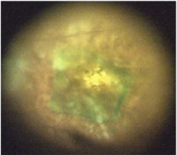 中心窩周囲内境界膜剥離術の術中写真