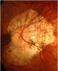 強度近視外来による視力障害を起こさないために